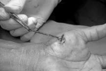 Người đàn ông ngỡ ngàng khi phát hiện "vật thể lạ" 4cm gây nguy hiểm ở tay