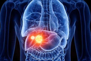 Ung thư gan giai đoạn cuối, tử thần không báo trước