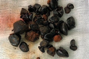 Lấy gần 50 viên sỏi mật cho cụ bà 88 tuổi