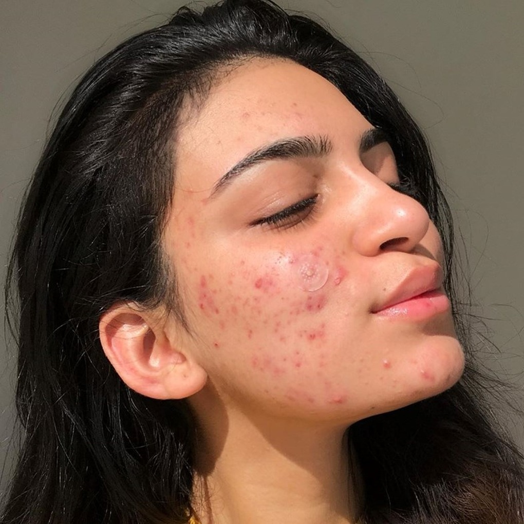 Bị mụn trứng cá: Nên và không nên ăn gì? - 1 Bị mụn trứng cá: Nên và không nên ăn gì? - 1