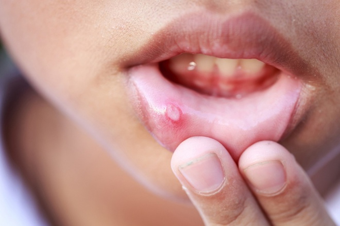 Miệng xuất hiện những dấu hiệu này có thể cảnh báo ung thư - 1 Miệng xuất hiện những dấu hiệu này có thể cảnh báo ung thư - 1