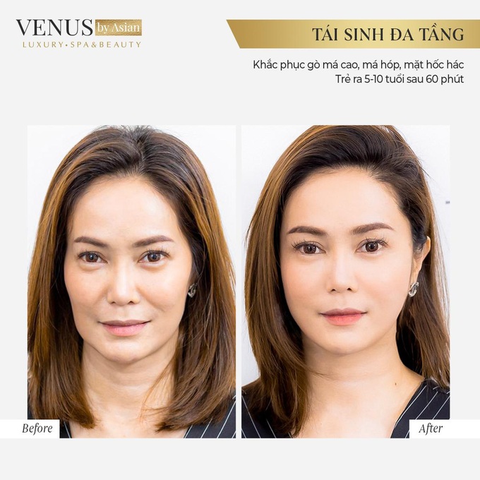 Trẻ ra 10 tuổi xuân chỉ sau 60 phút bằng Tái sinh đa tầng tại Venus by Asian. - Ảnh 1.