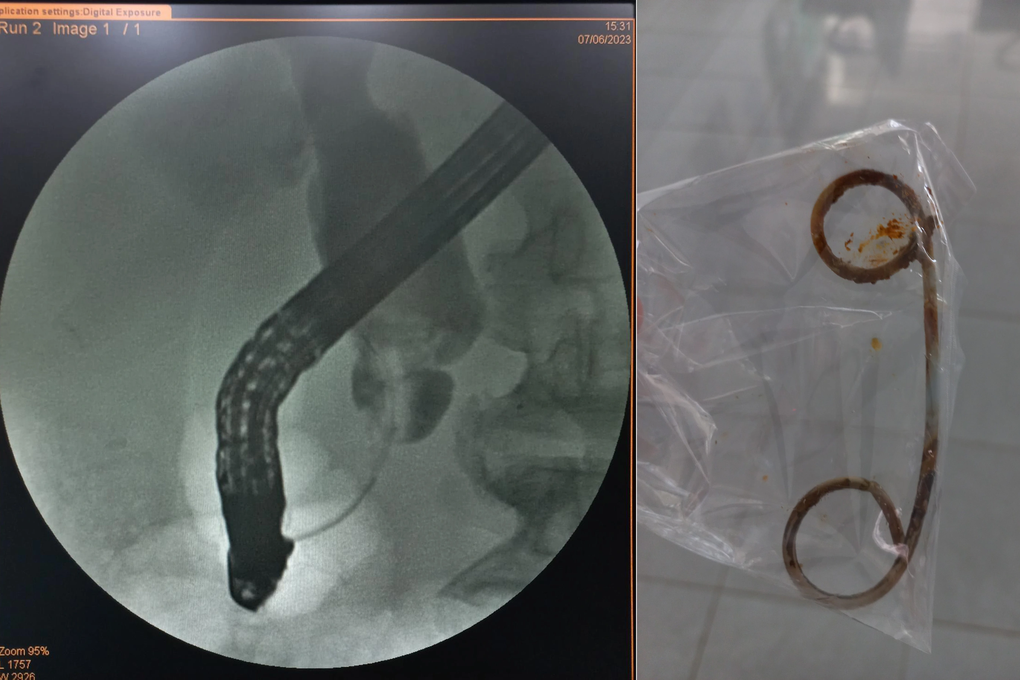 Nhiễm trùng nặng vì quên stent trong đường mật suốt 2 năm - 1 Nhiễm trùng nặng vì quên stent trong đường mật suốt 2 năm - 1