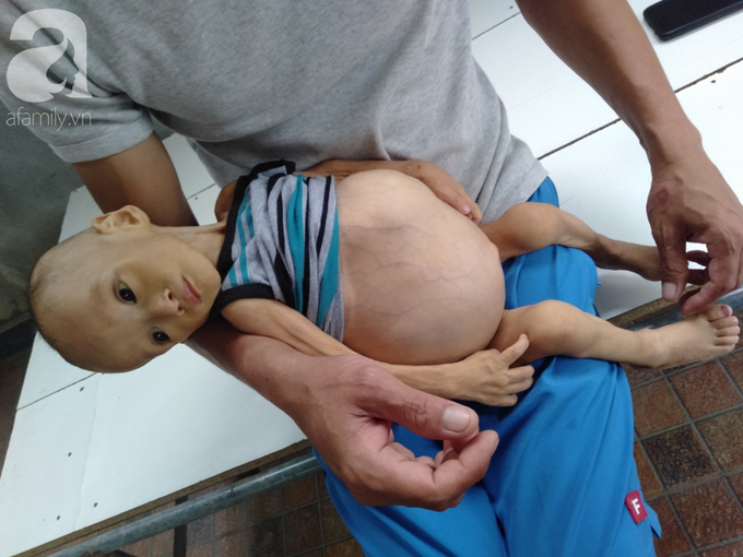 Sự sống mong manh của bé trai 1 tuổi, chỉ nặng 6kg, bụng phình to như cái trống mà mẹ nghèo không tiền chữa trị - Ảnh 7. Sự sống mong manh của bé trai 1 tuổi, chỉ nặng 6kg, bụng phình to như cái trống mà mẹ nghèo không tiền chữa trị - Ảnh 7.