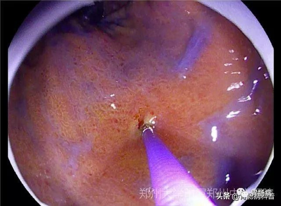 Cô gái mắc ung thư dạ dày dù không có biểu hiện gì, những người nào nên sàng lọc sớm? - 4 Cô gái mắc ung thư dạ dày dù không có biểu hiện gì, những người nào nên sàng lọc sớm? - 4