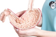 3 loại ung thư có tính di truyền cao, cần đề phòng nếu người thân mắc phải