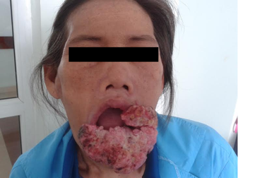 Hy hữu ca ung thư môi dưới "khủng"