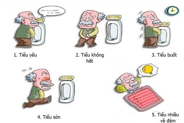 Phì đại tiền liệt tuyến: Nguyên nhân, triệu chứng và cách xử lý - 3 Phì đại tiền liệt tuyến: Nguyên nhân, triệu chứng và cách xử lý - 3