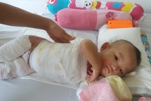 Thương cháu bé 11 tháng tuổi bị bỏng nước sôi nặng