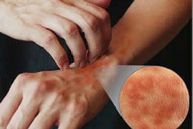 Dị ứng với nhiệt độ thấp