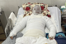 Nướng mực đãi tiệc cho thai phụ sắp sinh, 3 người trong nhà bỏng thương tâm