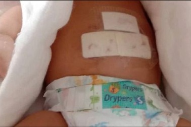 Em bé nguy kịch vì bị khỉ vào nhà cắn khi mẹ ở phòng khác