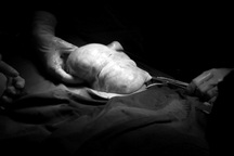 Người phụ nữ "vác" khối u buồng trứng khủng nặng 9kg