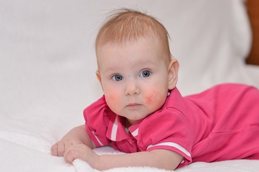 Cha mẹ nên biết: Các yếu tố gây dị ứng thực phẩm ở trẻ sơ sinh