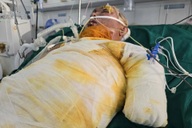 Mẹ ung thư đổ gục khi con trai bỏng điện bất động giữa ranh giới sinh tử