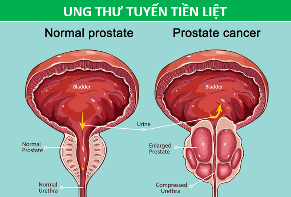 Đau vùng lưng dưới có thể là tín hiệu cảnh báo loại ung thư nào? - 4 Đau vùng lưng dưới có thể là tín hiệu cảnh báo loại ung thư nào? - 4
