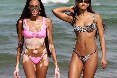 Winnie Harlow khoe dáng săn chắc và thanh mảnh