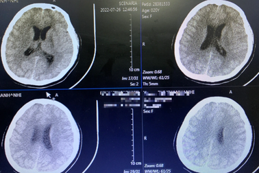 Cô gái trẻ hôn mê, trải qua hơn 30 ngày nằm viện sau điếu thuốc lá điện tử