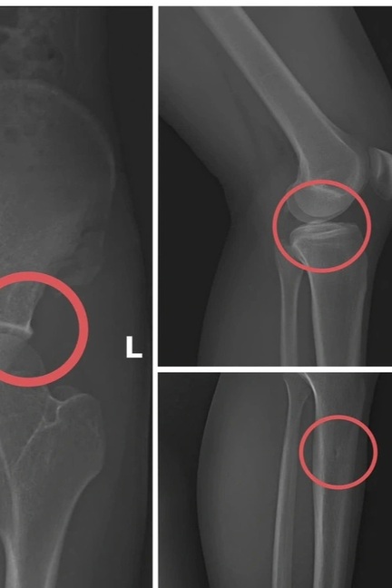 Tự đục vỡ xương để “qua mặt” bảo hiểm