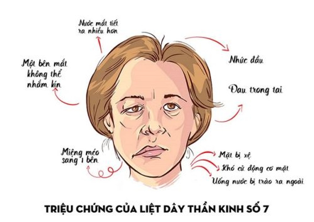 Bé 2 tuổi bị méo miệng vì sự chủ quan của người lớn - 2