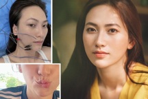 Phương Anh Đào bất ngờ chia sẻ bị lệch méo khuôn môi sau khi mổ tuyến giáp