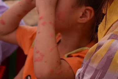 Chữa khỏi vẩy nến hoàn toàn: Chỉ là đồn thổi!