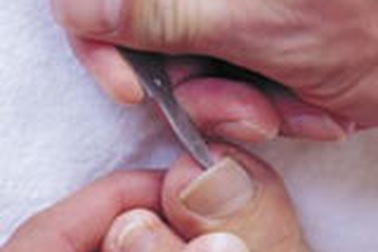 Phát bệnh vì cắt tỉa móng chân, móng tay