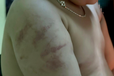 Đình chỉ công tác cô giáo "vịn tay" khiến bé 3 tuổi bầm cơ thể