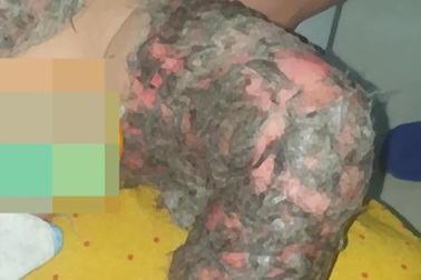 Sốc: Bệnh nhi 8 tháng tuổi được chữa bỏng bằng lông thú