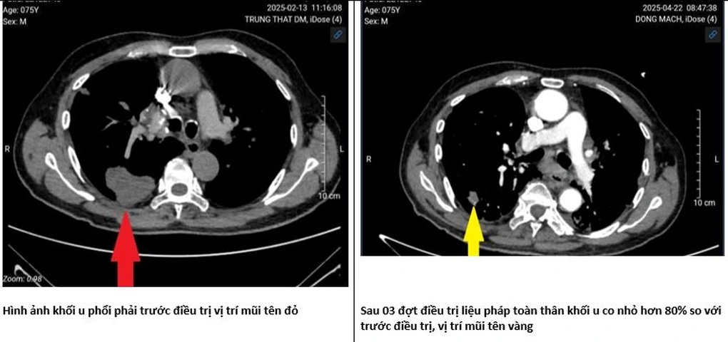 Vilka är resultaten av att vietnameser använder Người Việt dùng thuốc chữa ung thư “tương tự của Nga” kết quả thế nào? - 4