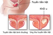 Dấu hiệu cảnh báo ung thư tiền liệt tuyến