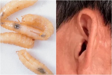 Hàng chục con giòi trong tai người đàn ông vì nguyên nhân hiếm gặp