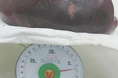 Cắt thành công lá lách 6,5kg