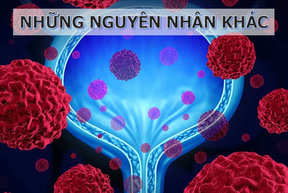 Nguy cơ mắc ung thư bàng quang từ chính nơi làm việc của bạn - 3 Nguy cơ mắc ung thư bàng quang từ chính nơi làm việc của bạn - 3