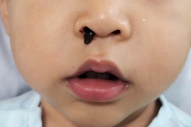 Kinh hãi bé trai bị con vắt chui vào mũi hút căng máu suốt 10 ngày