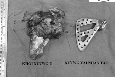 Đau vai suốt 5 năm, cô giáo tiểu học sốc khi phát hiện bị ung thư xương