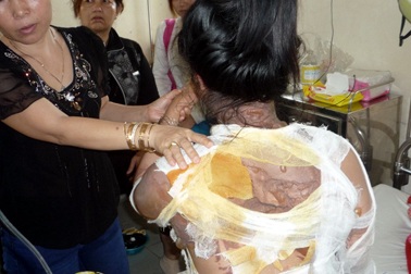 Phỏng nặng vì bị chồng tạt nồi nước sôi vào người