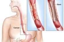 Dấu hiệu ung thư thực quản khi đã tiến triển