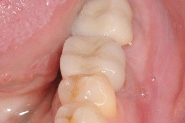 Công nghệ phục hình răng sứ trên implant DCT sắp có mặt tại Việt Nam