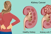 Chủ quan không tái khám, bệnh nhân ung thư thận nhập viện với khối u lớn