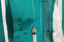 Rùng mình gắp giun lạ chưa từng có, dài tới 60cm ở tay chân bệnh nhân