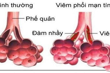 Bảo Phế Vương - Giải pháp “vàng” cho người bị bệnh viêm phổi
