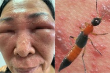 Hà Nội: Người phụ nữ không mở được mắt vì kiến ba khoang
