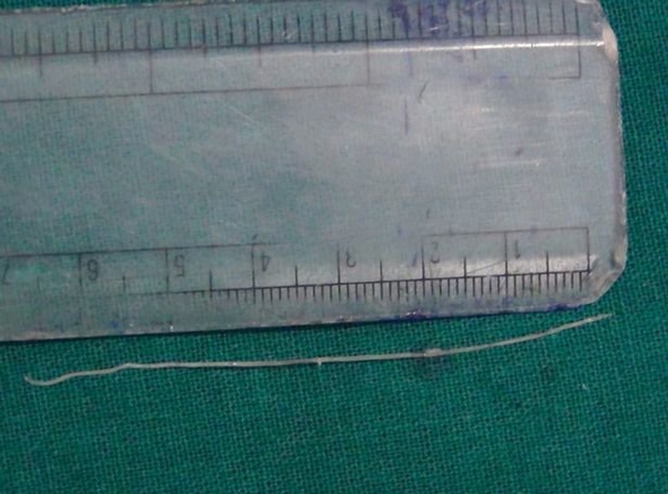 Sán dài 7cm ngọ nguậy trong mắt bệnh nhân - 3 Sán dài 7cm ngọ nguậy trong mắt bệnh nhân - 3