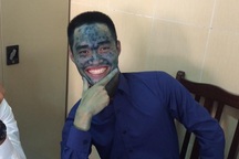 Nam sinh bị thuỷ đậu "xanh lét toàn thân" vẫn đứng bảo vệ tốt nghiệp