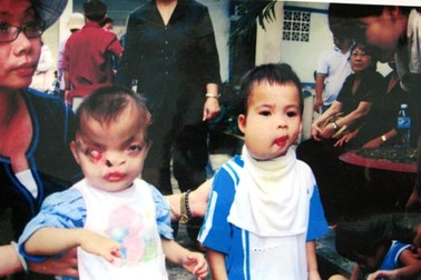 50 năm thảm họa da cam Việt Nam