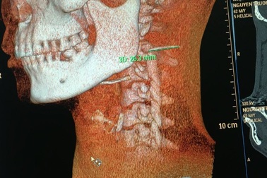 Phát hiện xương cá nằm trong cổ suốt 3 tháng sau khi chụp CT