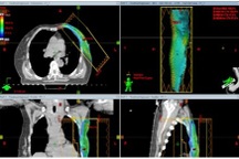 Ung thư vú, khi nào nên xạ trị?