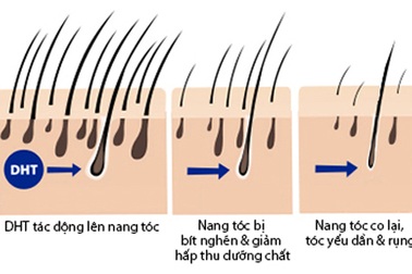 BS Trần Ngọc Ánh “giải mã” chứng rụng tóc