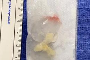 Nhức đầu đến nôn mửa vì…sán dây “trú ngụ” trong não